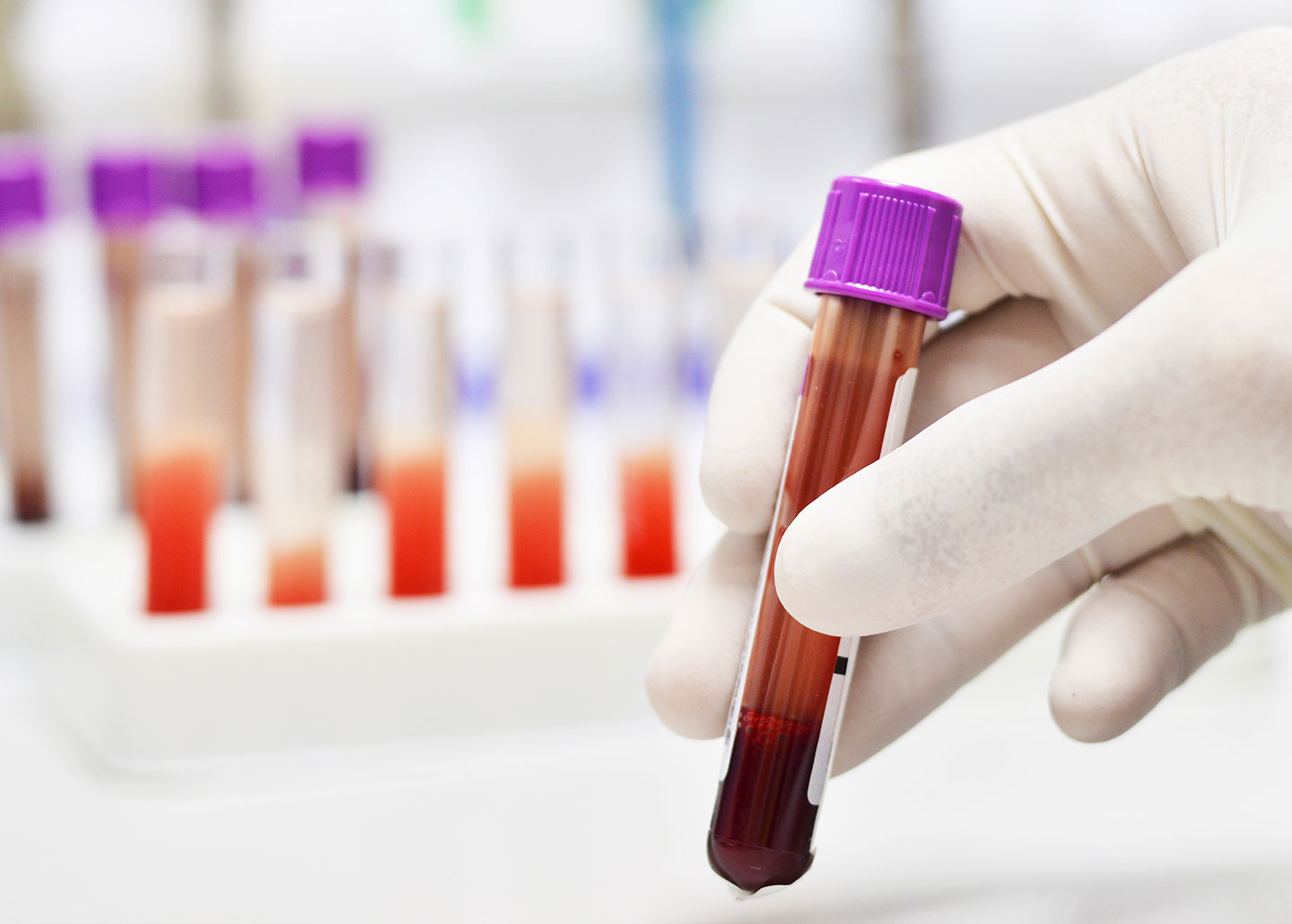 Leukemia：IL-6跨信號對CAR-T細(xì)胞抗腫瘤作用機制
